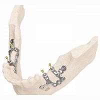 Dental surgical guide IUXTA 3D