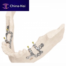 Dental surgical guide IUXTA 3D