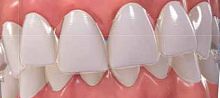 Dental aligner Invisalign