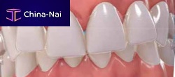 Dental aligner Invisalign