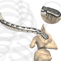 Clavicle compression plate AS.SH.029distallockingnon-locking