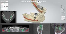 Guided surgery software for dental implantologyplanning