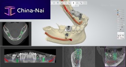 Guided surgery software for dental implantologyplanning