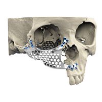 Custom-made periorbital implant