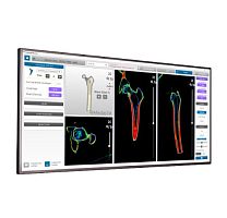 CT software MyHip®analysisplanninghip