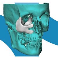 Custom-made periorbital implant 4353