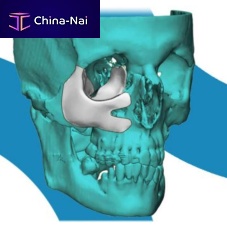 Custom-made periorbital implant 4353