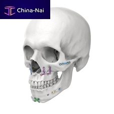 Genioplasty compression plate lockingmetallic