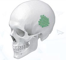 Non-absorbable cranial fixation system 4003008