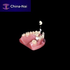 Titanium implant abutment zirconiaPEEKinternal