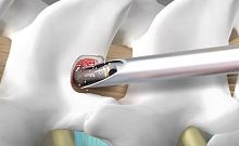 Spine surgery burr UDB-20-13-40diamondcutting