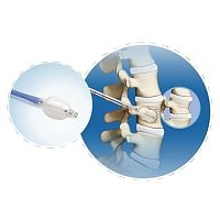 Percutaneous kyphoplasty instrument kit FWS-007 seriessingle-use