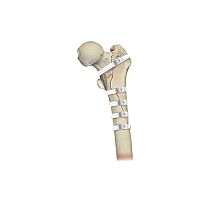 Hip revision surgery bone cerclage wiring Ortholox® UHMWPEmultifilament polymer