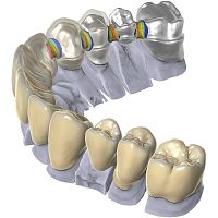 Dental software exocadCAD