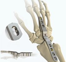 Carpal joint arthrodesis plate 1022-0008lockingmetallic