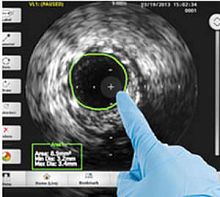 Intravascular ultrasound imaging software COREanalysis