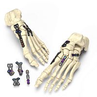 Hindfoot arthrodesis plate Stratum®forefootlocking