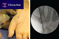 Metacarpophalangeal joint arthrodesis screw REDUCThand phalangeheadlessmetallic