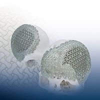 Custom-made cranial implant REAL FIT