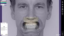 Dental software Smile Creatorfor dental laboratoriesanalysisplanning