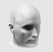 Synthetic bone substitute Mimix®for maxillofacial surgeryputty