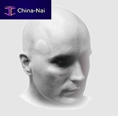 Synthetic bone substitute Mimix®for maxillofacial surgeryputty