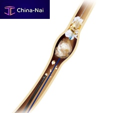Stone extraction catheter ureteralhydrophilic