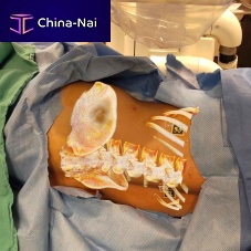AR surgical navigation system OpenSight®spine surgeryorthopedic surgeryoptical