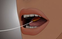 Non-surgical intragastric balloon Elipse