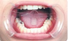 Cheek retractor 2060A tonguedentaldisposable