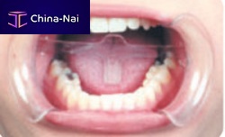 Cheek retractor 2060A tonguedentaldisposable