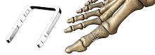 Forefoot bone staple CHARLOTTEnon-absorbable