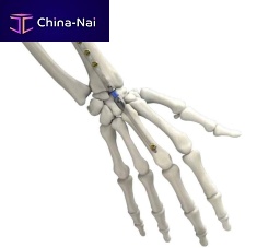 Wrist intramedullary nail IMPLATE ®