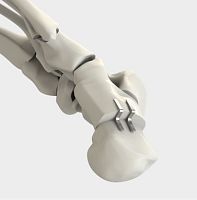 Calcaneal displacement osteotomy bone staple DynaFORCE® Stepnon-absorbable