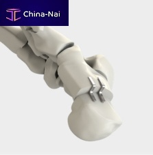 Calcaneal displacement osteotomy bone staple DynaFORCE® Stepnon-absorbable