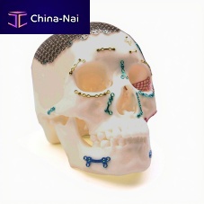 Non-absorbable cranial fixation system MCF