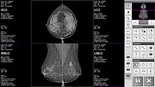 Mammography software BRESTATION LITEimage analysismanagementdiagnostic