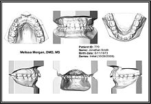 Dental laboratory software Ortho Insight 3D Full / Litefor dental prosthesis designCAD3D viewing
