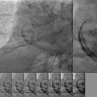 Medical imaging software SCORE StentViewvisualizationdiagnostic