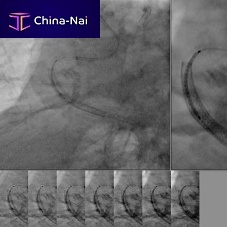 Medical imaging software SCORE StentViewvisualizationdiagnostic