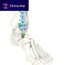 Ankle arthrodesis plate ARIX 3.5medialdistallocking