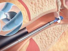 Tympanostomy tube HUMMINGBIRD® TTS