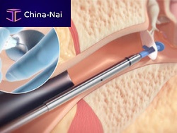 Tympanostomy tube HUMMINGBIRD® TTS