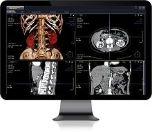 Dental implant simulation software XelisCTfor DICOM filesangiography