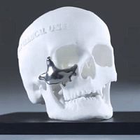 Custom-made periorbital implant