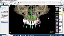 Dental implantology software NemoScanclinicalhospitallaboratory