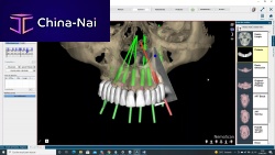 Dental implantology software NemoScanclinicalhospitallaboratory