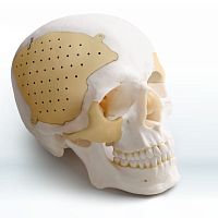 Custom-made cranial implant Recranio