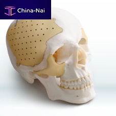 Custom-made cranial implant Recranio