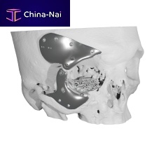 Maxillofacial compression plate Custom-made implantmetallic
